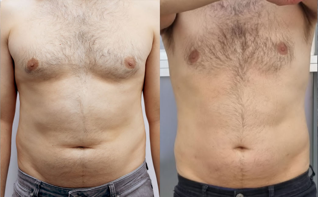 Resultado abdomen 1