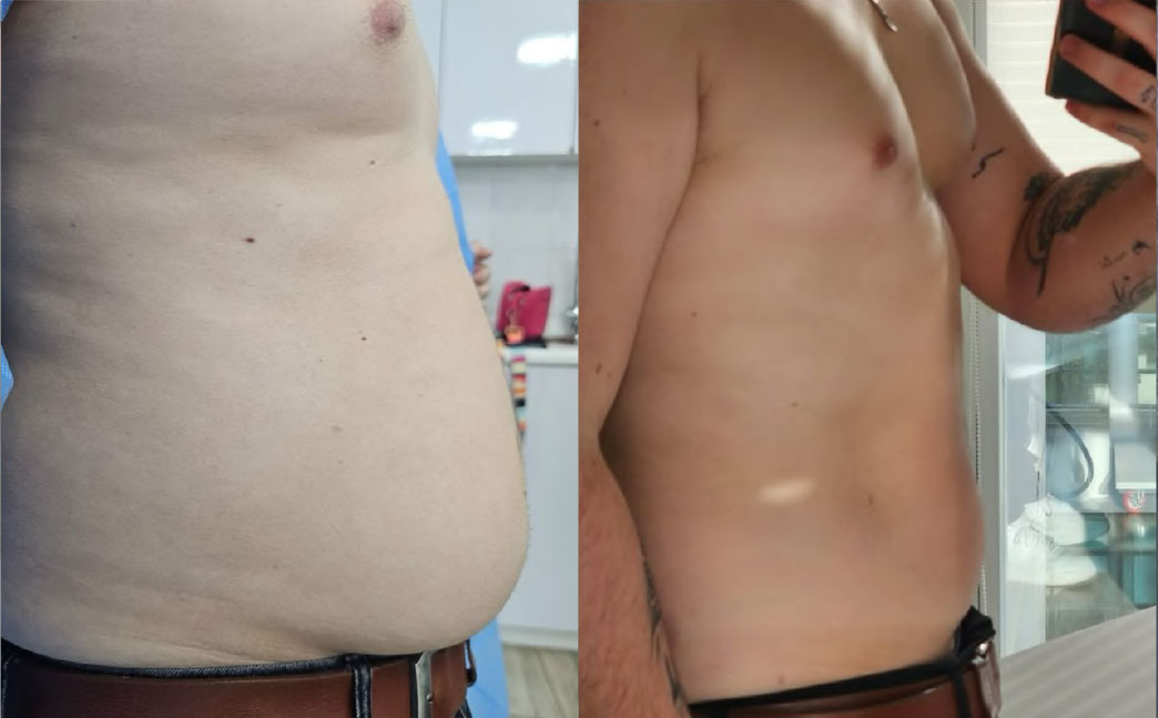 Resultado abdomen 2