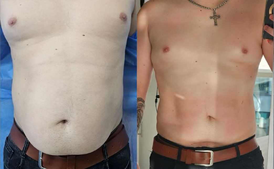 Resultado abdomen 3