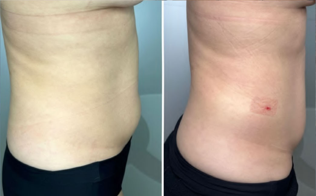 Resultado abdomen 4