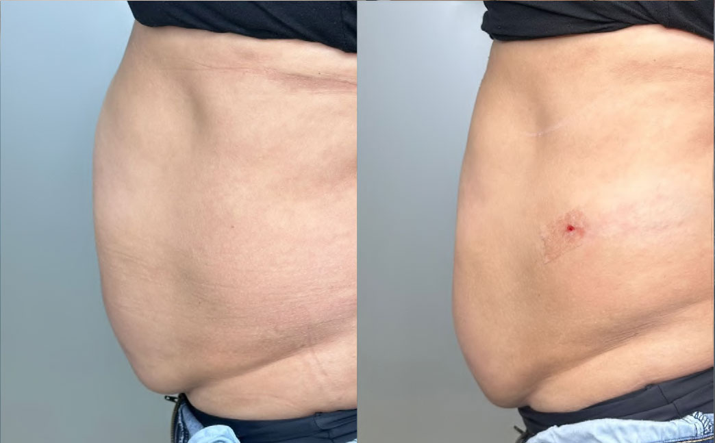 Resultado abdomen 5