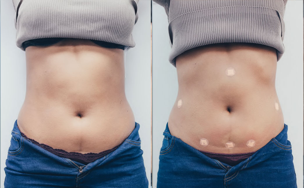 Resultado abdomen 6